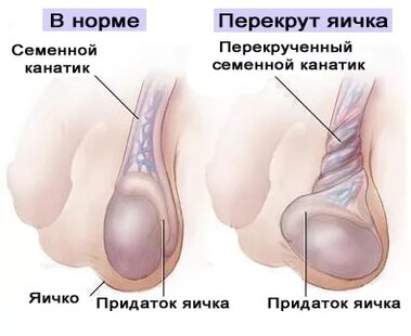 яички мальчика Все о перекруте яичка у детей и взрослых