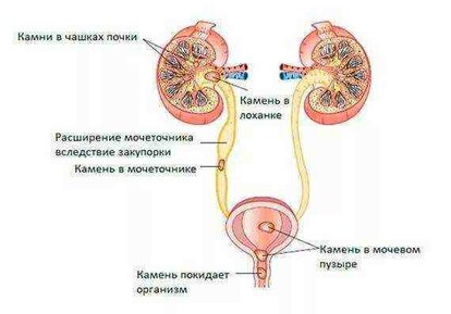 Песок в моче