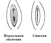 Как должны выглядеть половые губы девочек Сращение малых половых губ