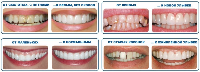 Как заменить передние зубы