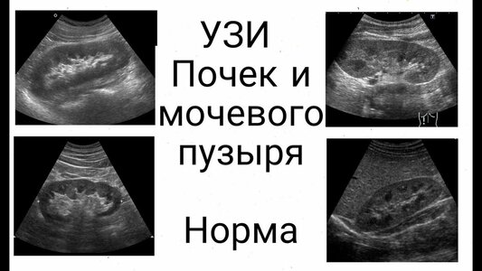 Узи почек норма у детей таблица