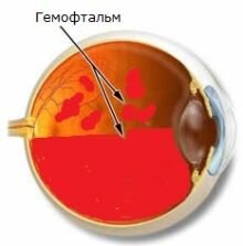 Глазные капли от кровоизлияния в белок глаза