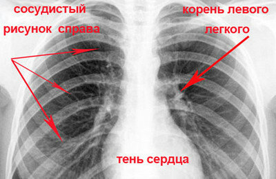 Что значит усиление легочного рисунка в нижних отделах