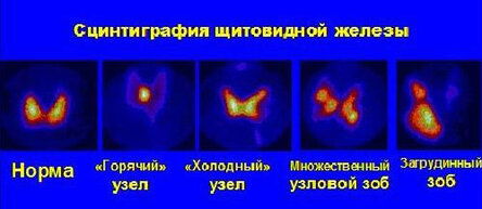 Симптомы и лечение узлов в щитовидной железе
