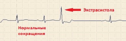 экстрасистола