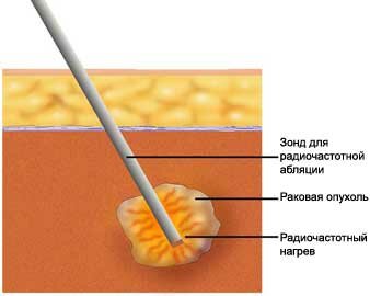 Узловой зоб щитовидной железы