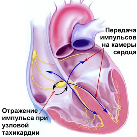 Тахикардия: симптомы, лечение