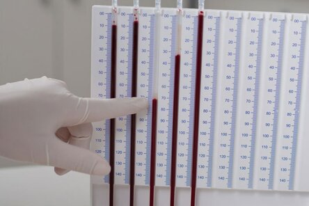 СОЭ повышена у взрослого, о чем это говорит?