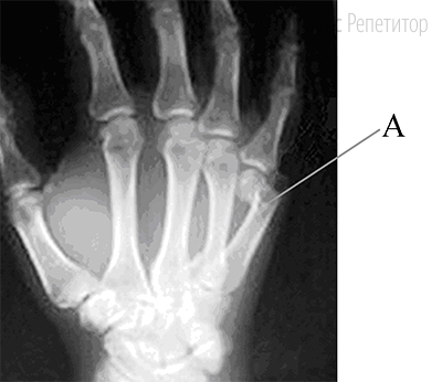 Как называют повреждение, обозначенное на рентгеновском снимке буквой ...?