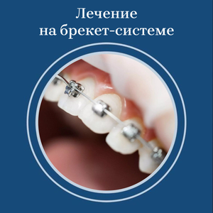 Лечение на брекетах от