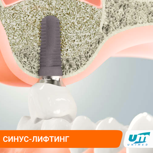 Синус-лифтинг. Наращивание объема костной ткани