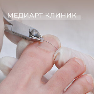 Подолог - Медицинский педикюр, установка титановой нити