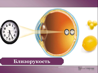 Близорукость (миопия)