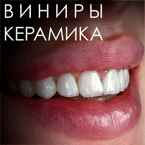 Виниры керамические