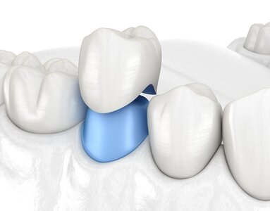 Коронка керамическая IPS E.max Press