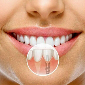 Импланты Dentium Superline Скидка 25%