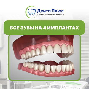 Все зубы на 4 имплантатах (all on 4), диоксид циркония 