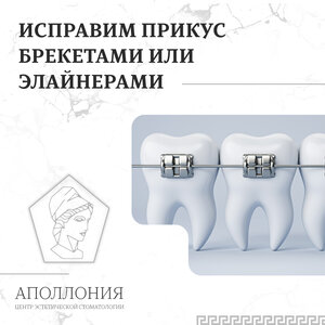 Исправление прикуса