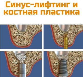 Закрытый синус-лифтинг