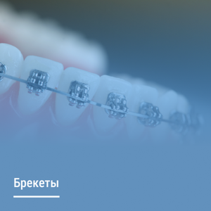 Установка брекетов