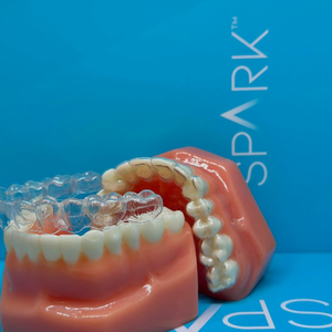 Американские элайнеры Spark, Invisalign