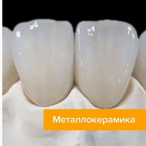 Металлокерамическая коронка под ключ 5600 рублей