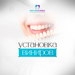 Установка виниров