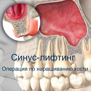Синус лифтинг открытый