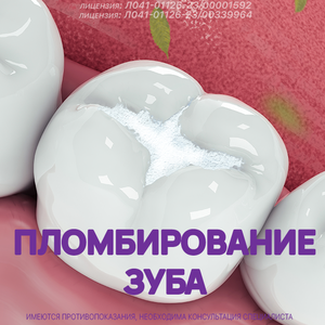 Пломбирование полостей фотополимером