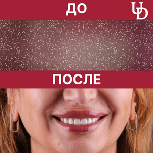 Зубные импланты Straumann со скидкой 25%