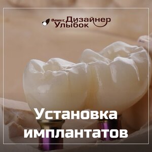 Установка имплантатов от