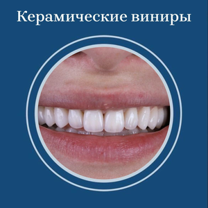 Керамические виниры от 