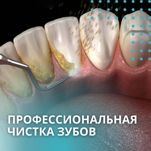Профессиональная чистка зубов