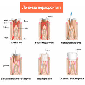 лечение периодонтита