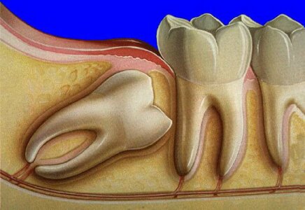 Удаление зуба мудрости ультразвуком PIEZOSURGERY