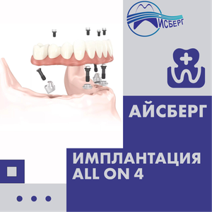 Имплантация всех зубов за 1 день. Акция на All-on-4!