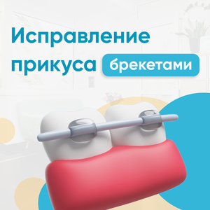 Брекеты