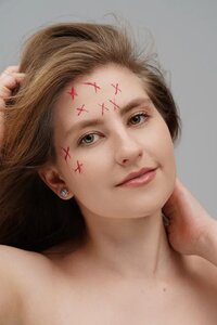 Удаление сосудов