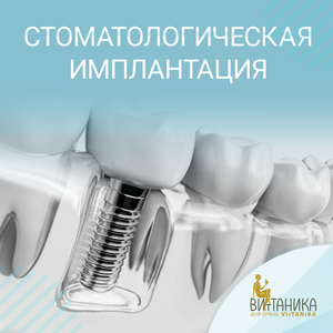 Имплантация стоматологическая "OSSTEM"