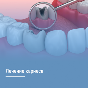 Лечение кариеса