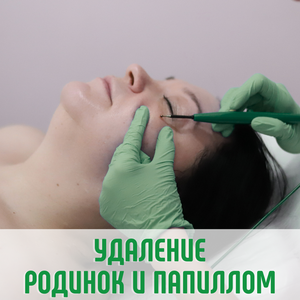 Удаление родинок и папиллом