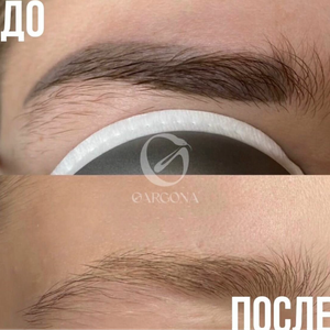 Удаление татуажа в ноль с гарантией