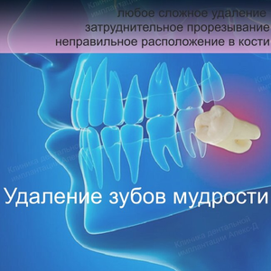 Удаление зуба мудрости