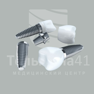 Имплантация зубов