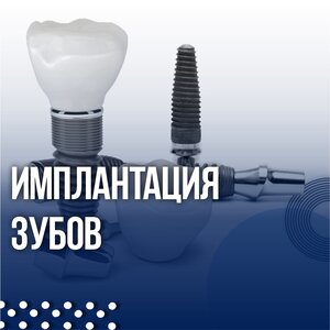 Имплантация зубов