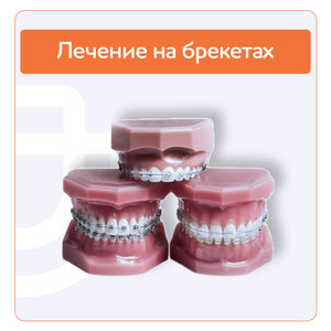 Установка брекетов