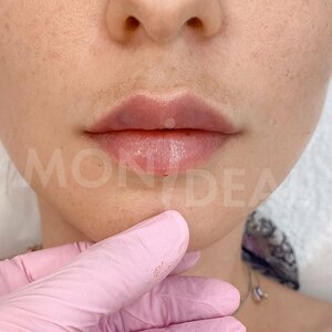 Контурная пластика губ Juvederm smile (0,55 мл)