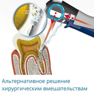 Парадонтология — лечение аппаратом "Вектор". Альтернатив