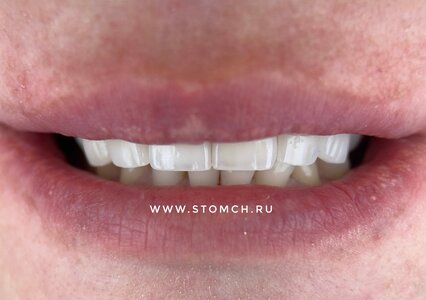 Немецкая имплантация
