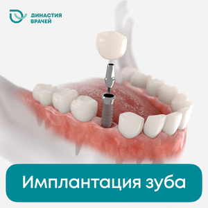 Имплантация зуба
